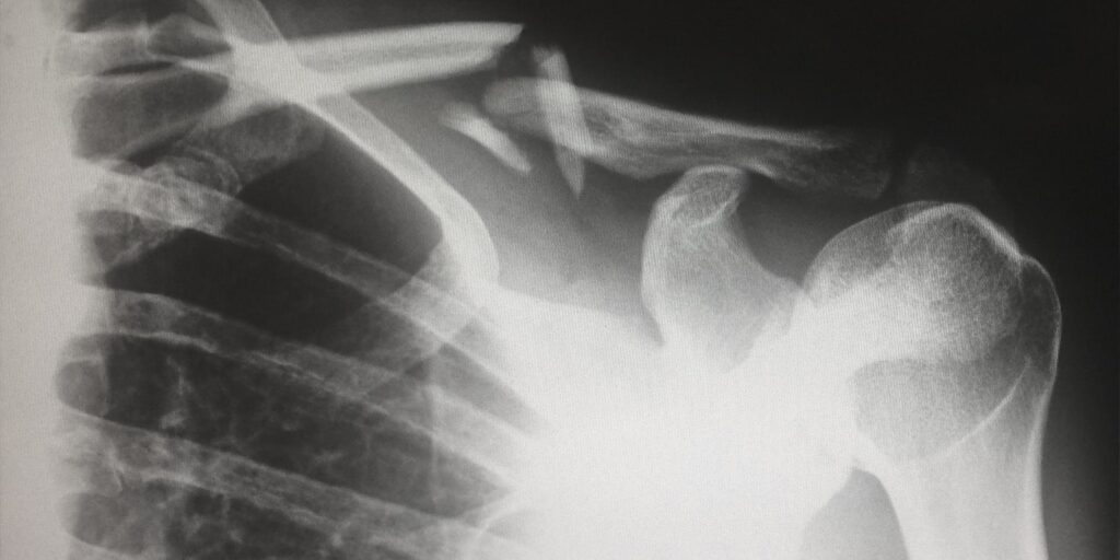 An xray medical record showing broken bones